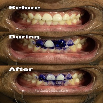 side by side comparison ad template — HiSmile